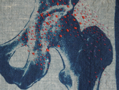 Pain Map: Close up photo of fabric with a hip joint x-ray printed in shades of blue, area visible is the ball and socket joint of the acetabulum and femoral head, and the sitz bone or ischial tuberosity. Small red stitches are scattered around the joint, indicating varying intensities of pain, most densely stitched around the acetabulum. 